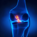 COMPARISON OF FEMORAL TUNNEL GEOMETRY, USING IN VIVO 3-DIMENSIONAL COMPUTED TOMOGRAPHY, DURING TRANSPORTAL AND OUTSIDE-IN SINGLE-BUNDLE ANTERIOR CRUCIATE LIGAMENT RECONSTRUCTION TECHNIQUES