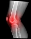 LEVELS OF NEUROPEPTIDE Y IN SYNOVIAL FLUID RELATE TO PAIN IN PATIENTS WITH KNEE OSTEOARTHRITIS